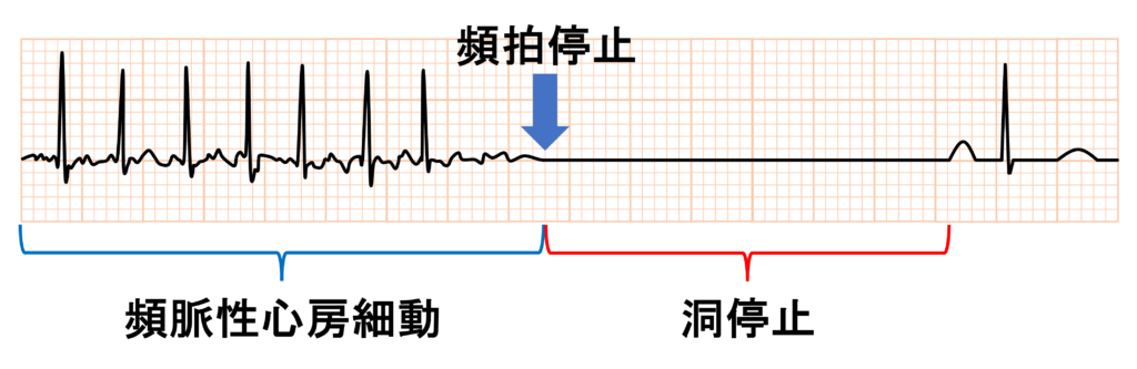 徐脈頻脈症候群(tachycardia-bradycardia syndrome)