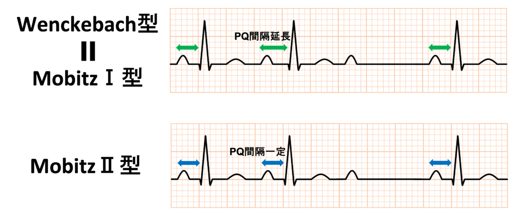 Wenckebach現象(Wenckebach phenomenon)