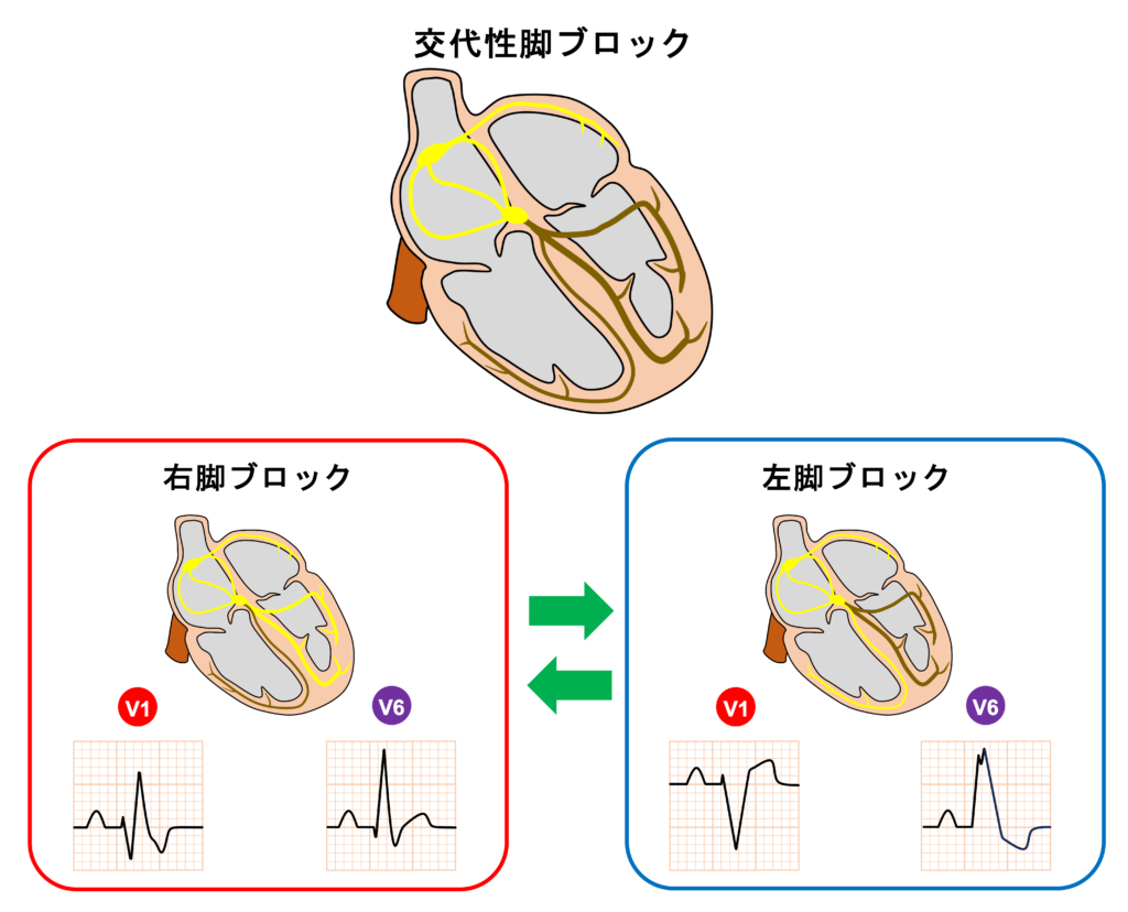 交代性脚ブロック(Alternating bundle branch block)