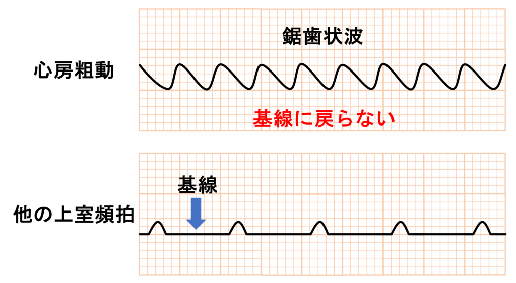 心房粗動(Atrial flutter)