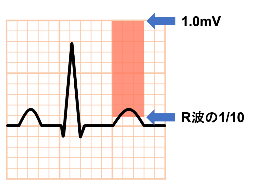 T波(T wave)