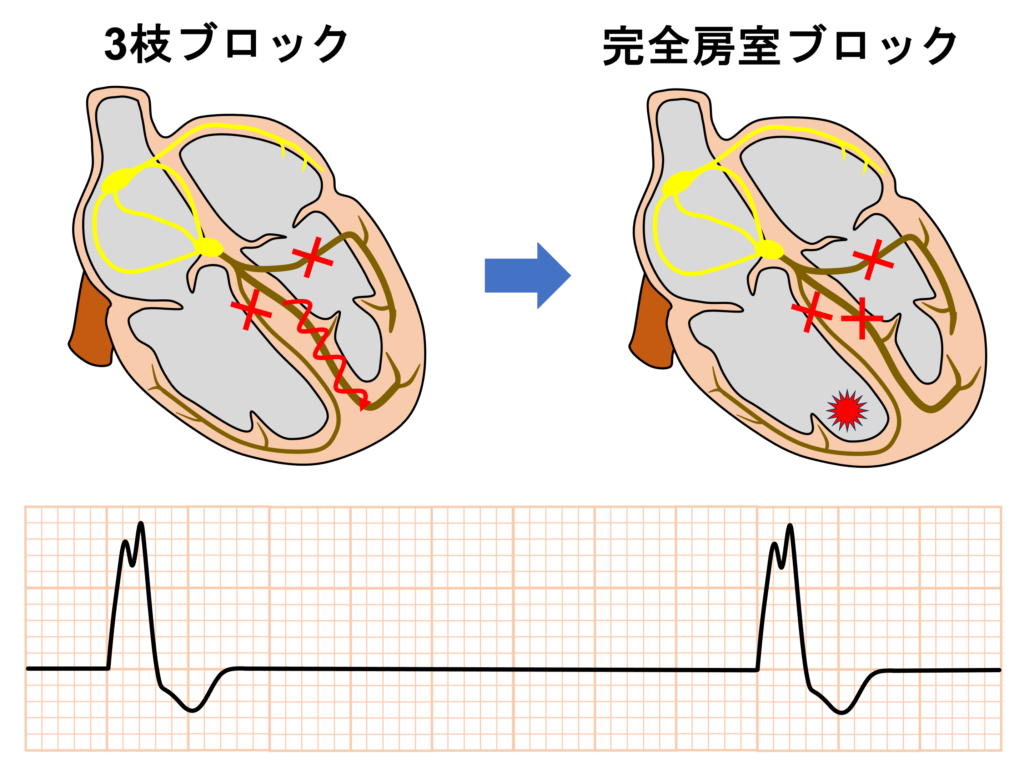 ３枝ブロック(trifascicular block)