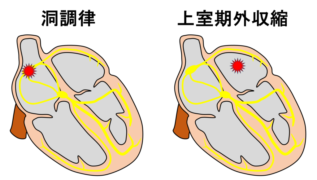 上室期外収縮(Supraventricular premature contraction：SVC)