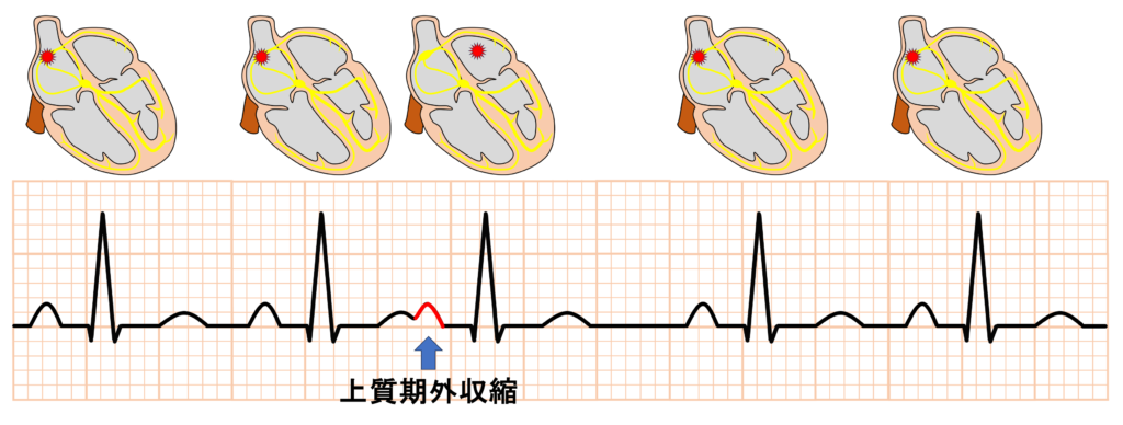 上室期外収縮(Supraventricular premature contraction：SVC)