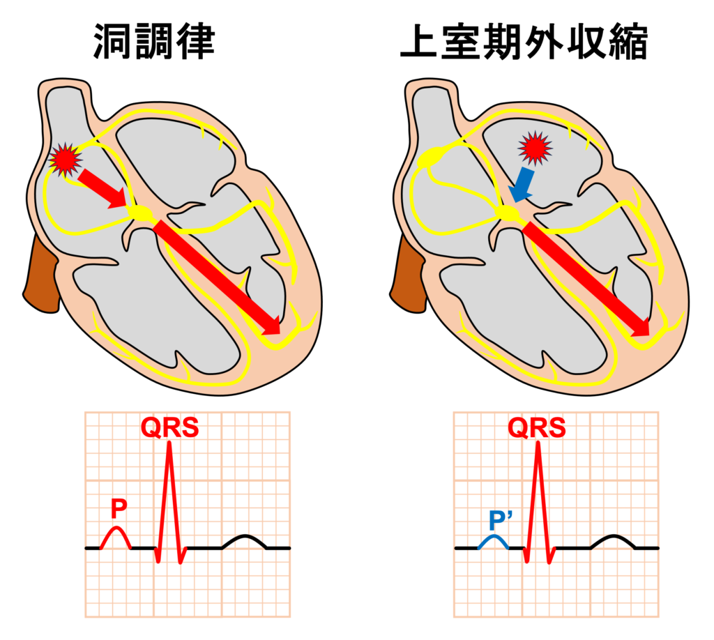 上室期外収縮(Supraventricular premature contraction：SVC)