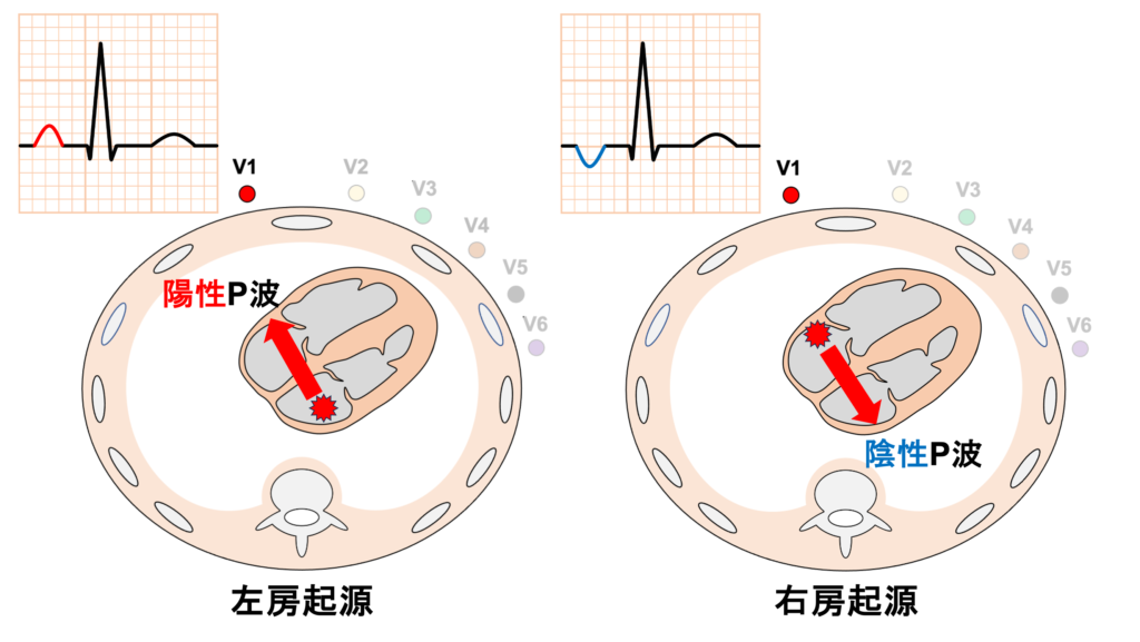 上室期外収縮(Supraventricular premature contraction：SVC)