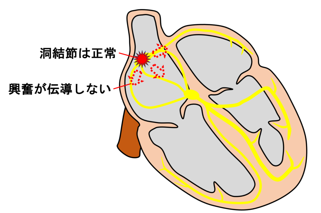 洞房ブロック(sinoatrial block)