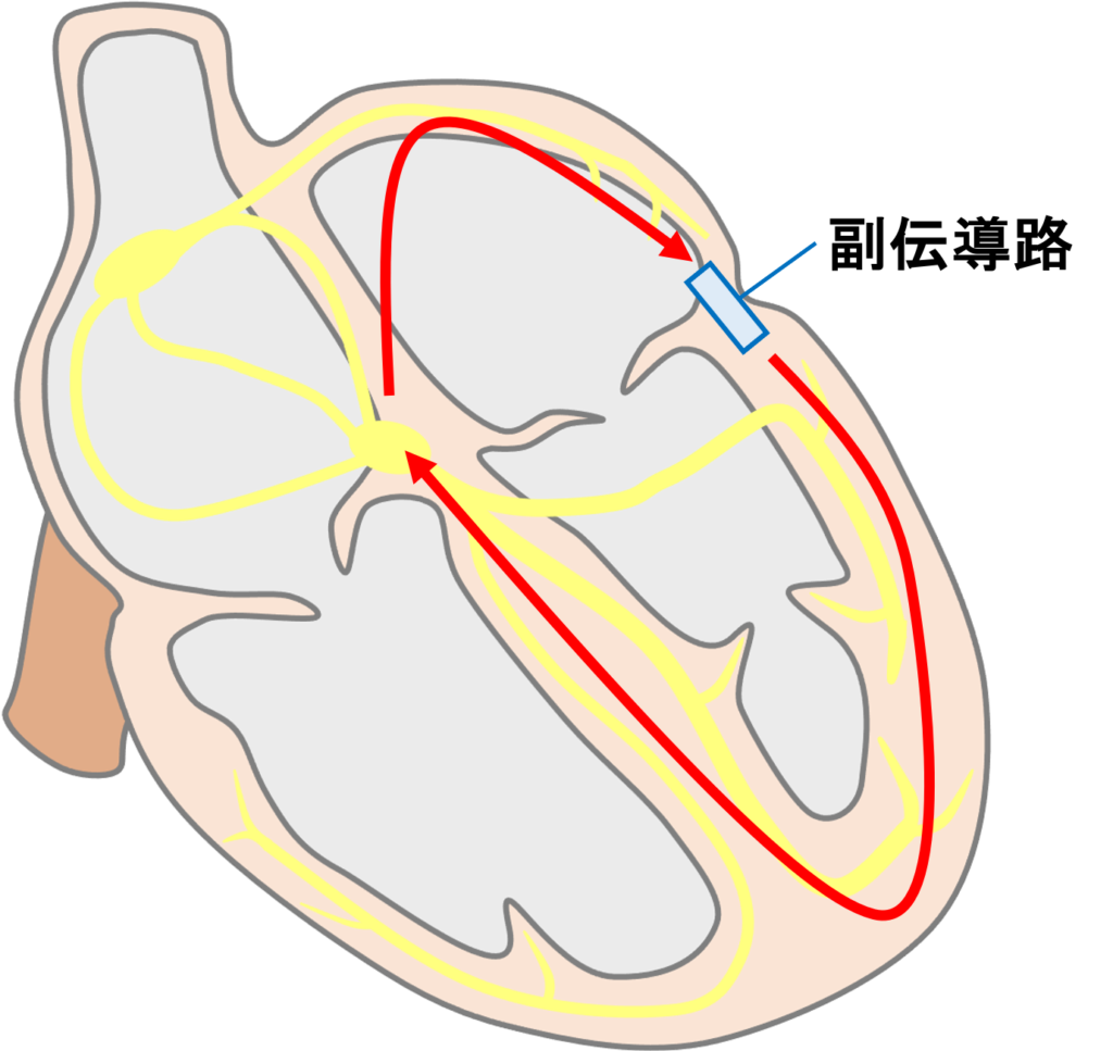 房室回帰性頻拍(atrioventricular reentrant tachycardia：AVRT)