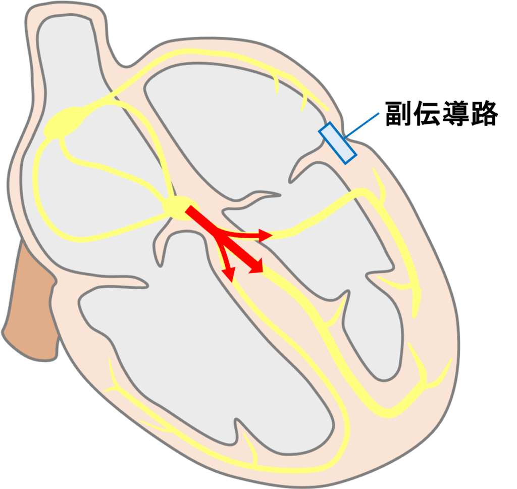 房室回帰性頻拍(atrioventricular reentrant tachycardia：AVRT)