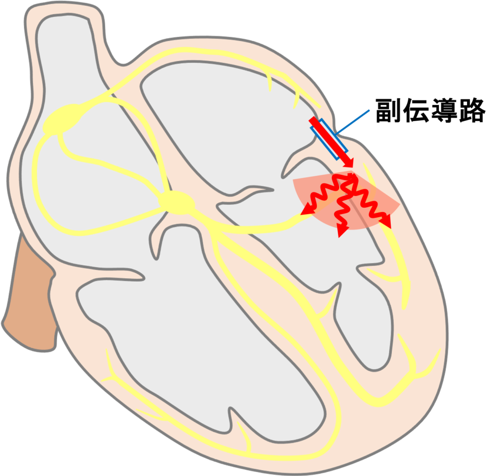 房室回帰性頻拍(atrioventricular reentrant tachycardia：AVRT)