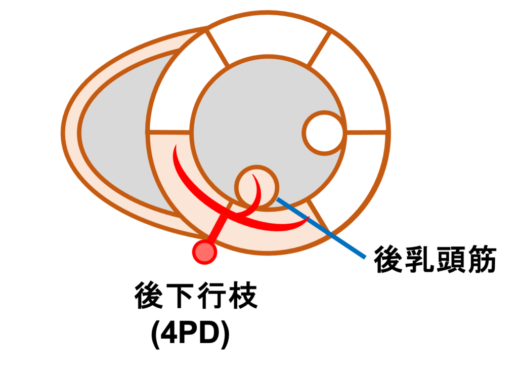 下壁心筋梗塞(inferior myocardial infarction)