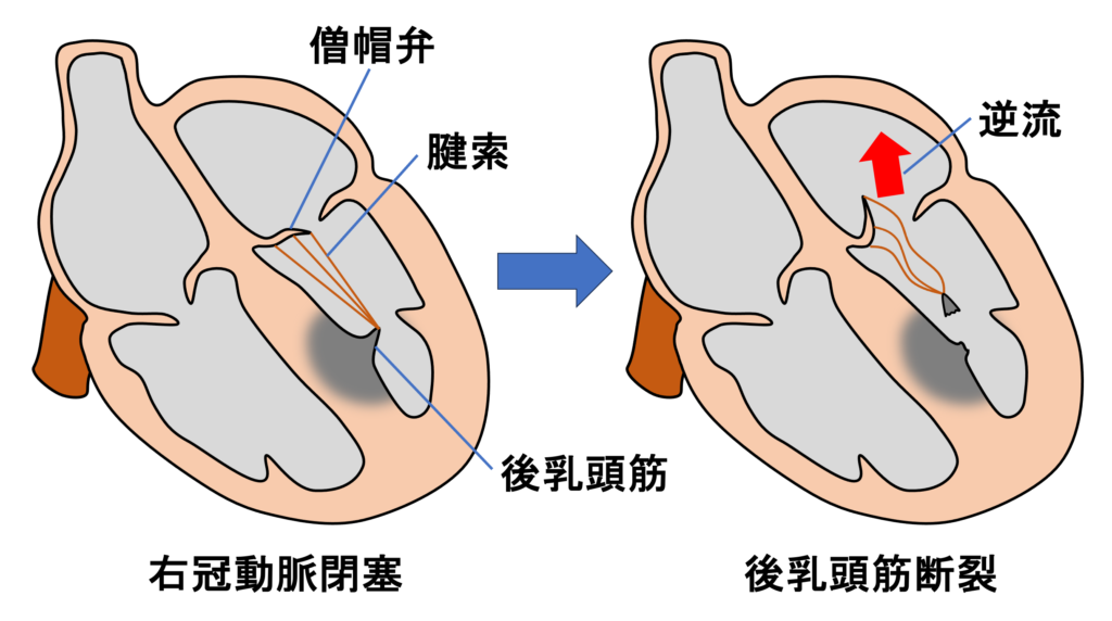 下壁心筋梗塞(inferior myocardial infarction)