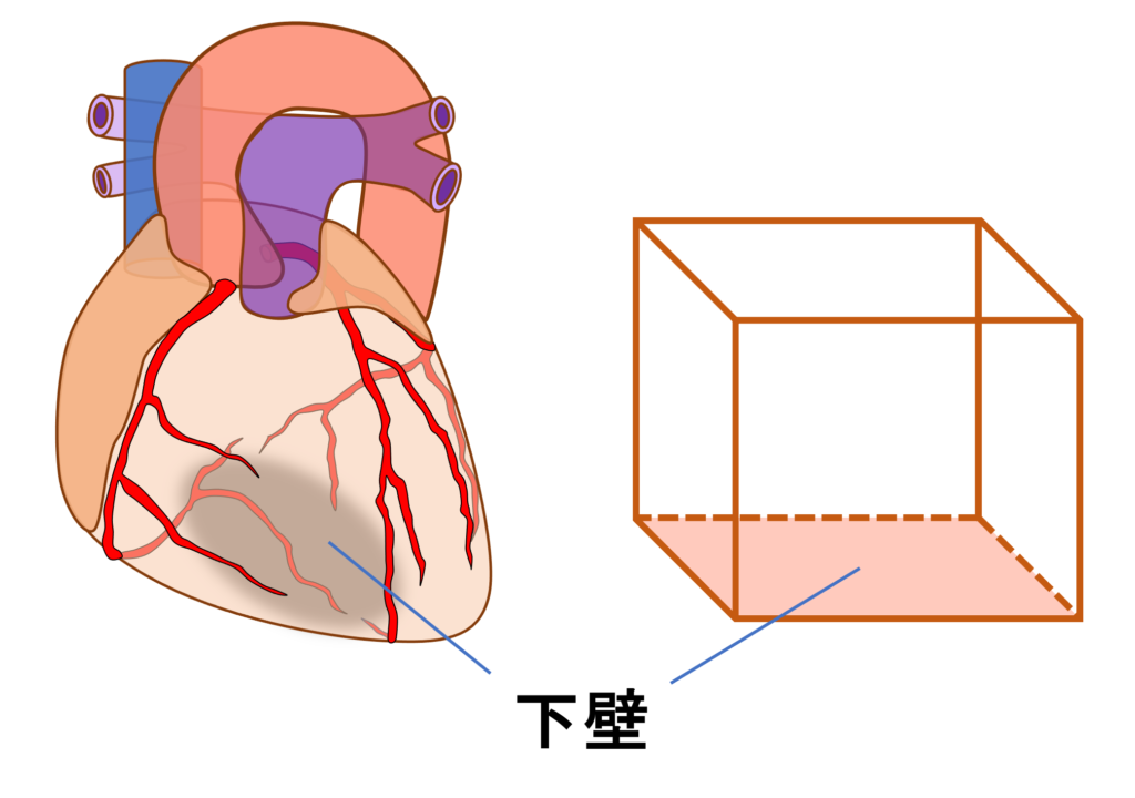 下壁心筋梗塞(inferior myocardial infarction)