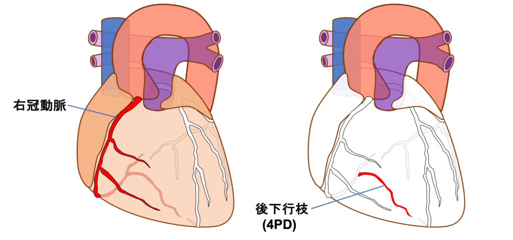 下壁心筋梗塞(inferior myocardial infarction)