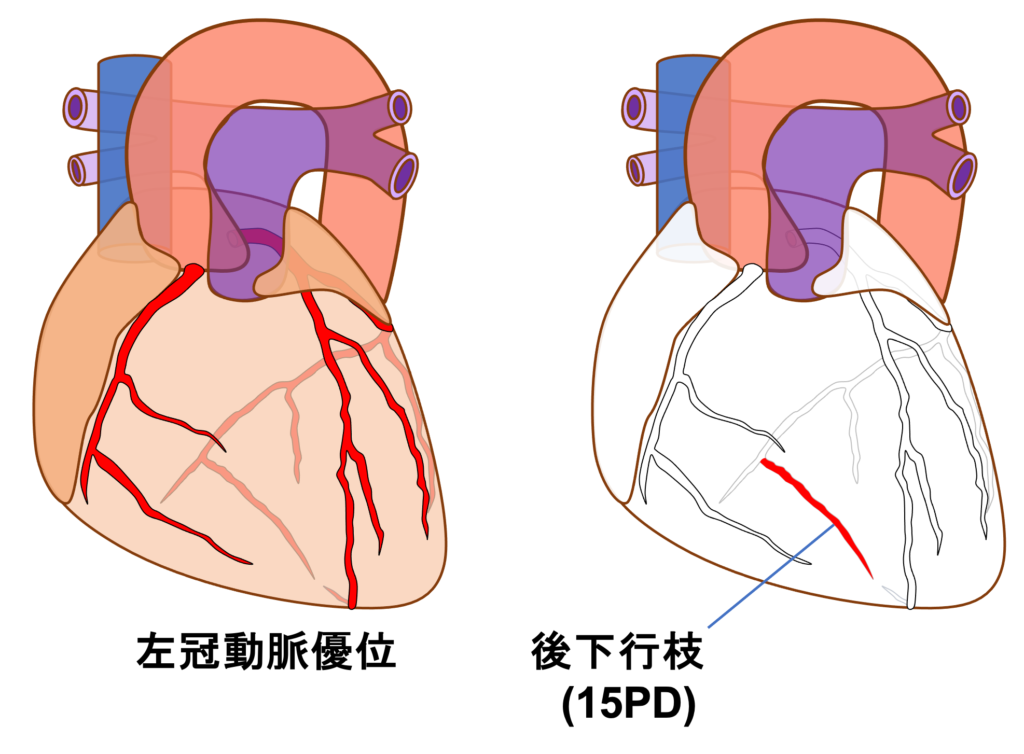 下壁心筋梗塞(inferior myocardial infarction)