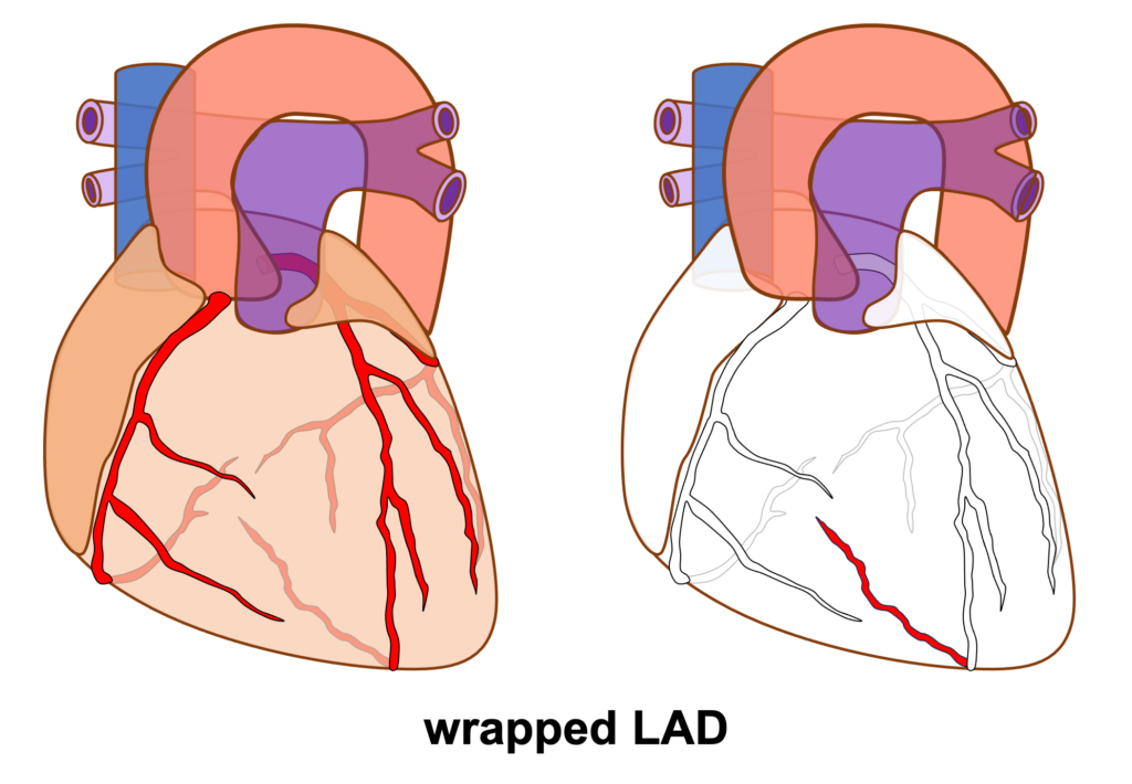 下壁心筋梗塞(inferior myocardial infarction)