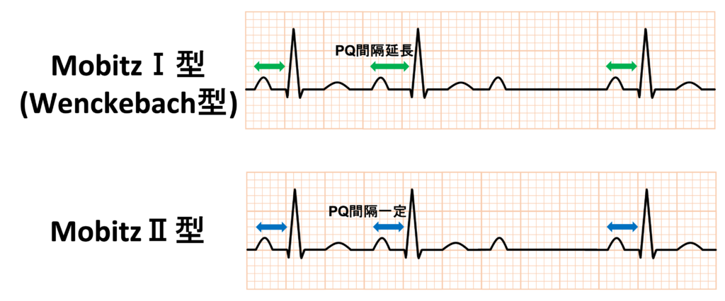 MobitzⅡ型Ⅱ度房室ブロック(Mobitz typeⅡ second degree atrioventricular block)