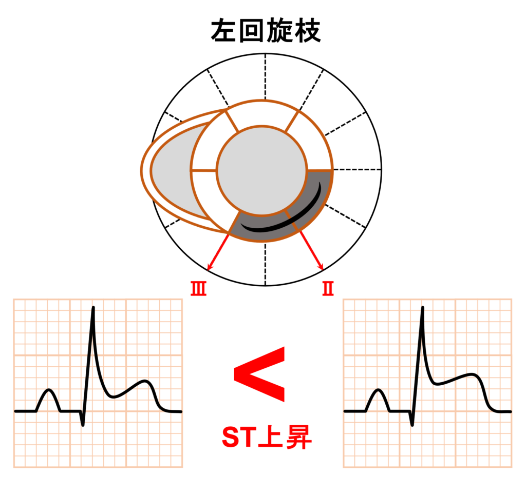 下壁心筋梗塞(inferior myocardial infarction)