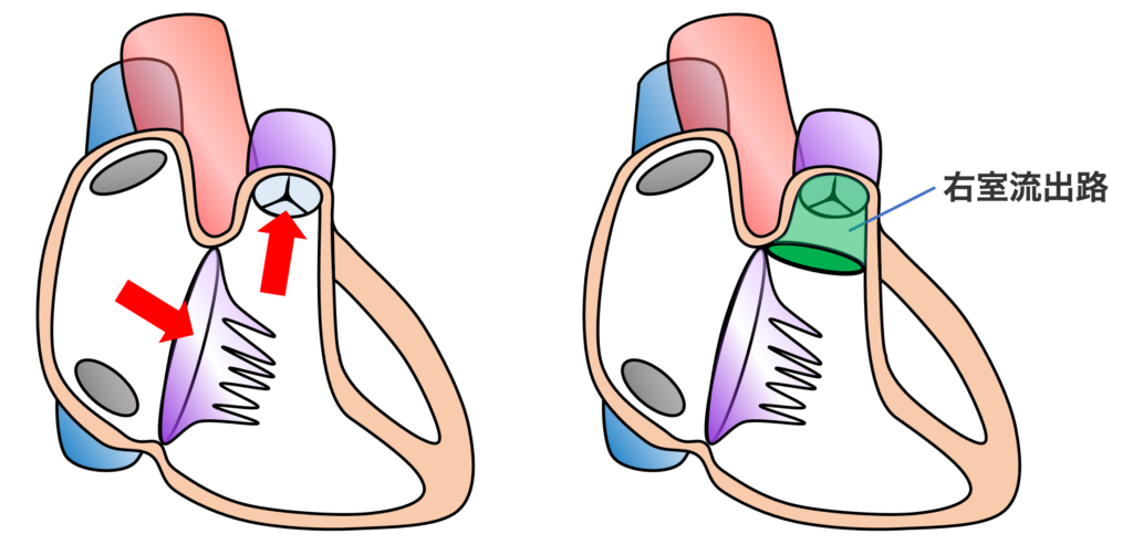 右室流出路(right ventricular outflow tract：RVOT)　