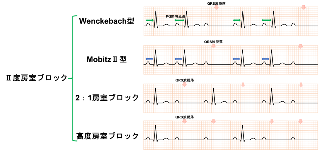 Ⅱ度房室ブロック(second degree atrioventricular block)