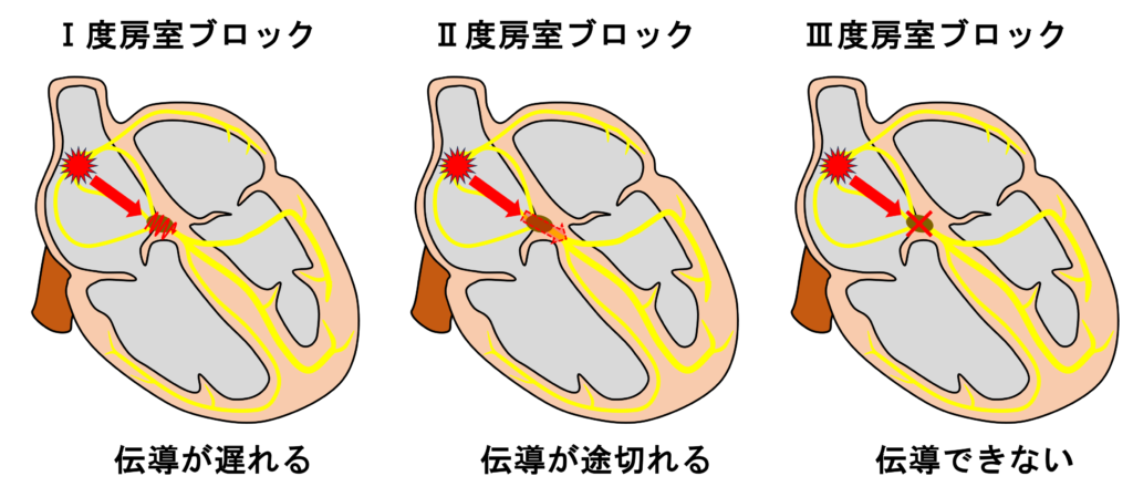 Ⅱ度房室ブロック(second degree atrioventricular block)