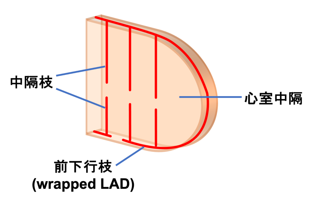 下壁心筋梗塞(inferior myocardial infarction)