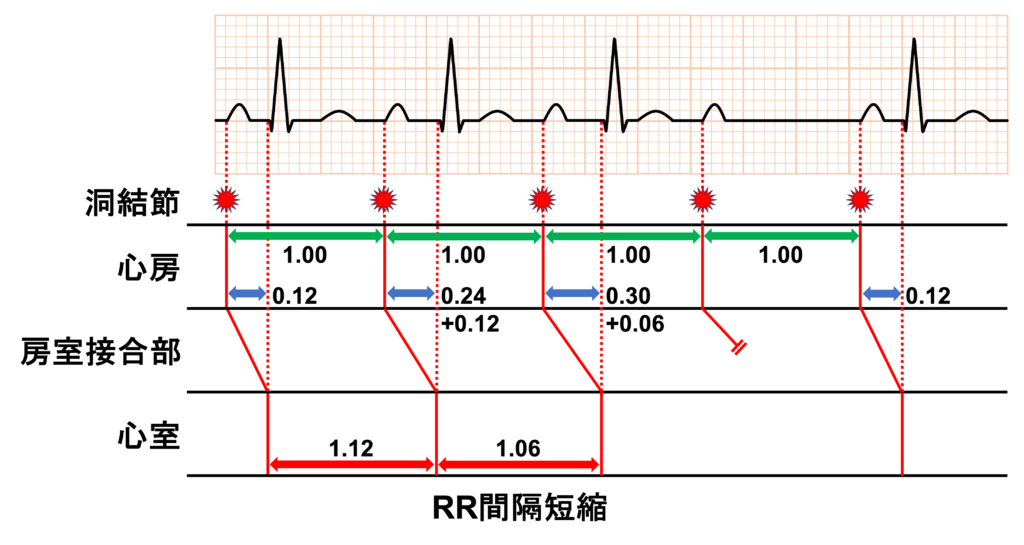 Wenckebach型Ⅱ度房室ブロック(Wenckebach second degree atrioventricular block)