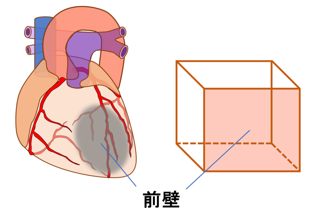 前壁心筋梗塞(anterior myocardial infarction)