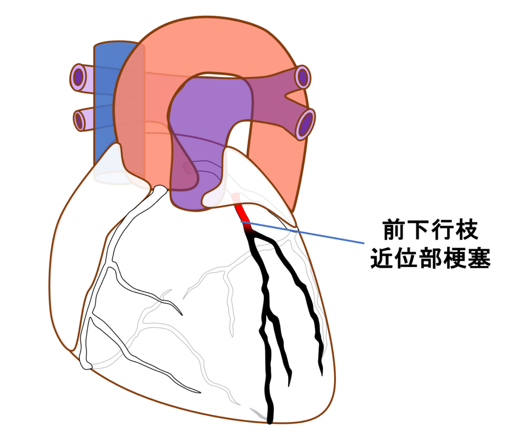 前壁心筋梗塞(anterior myocardial infarction)