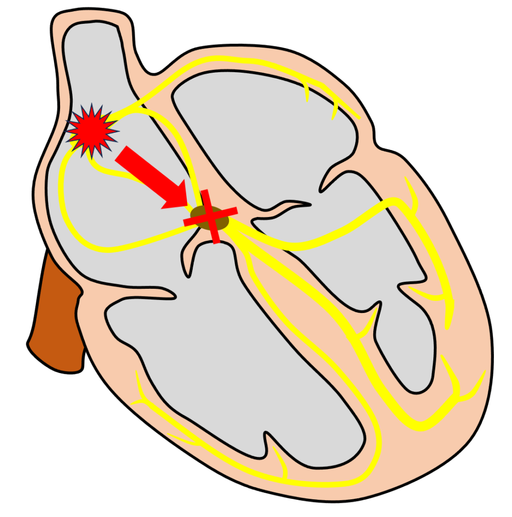 完全房室ブロック(complete atrioventricular block)