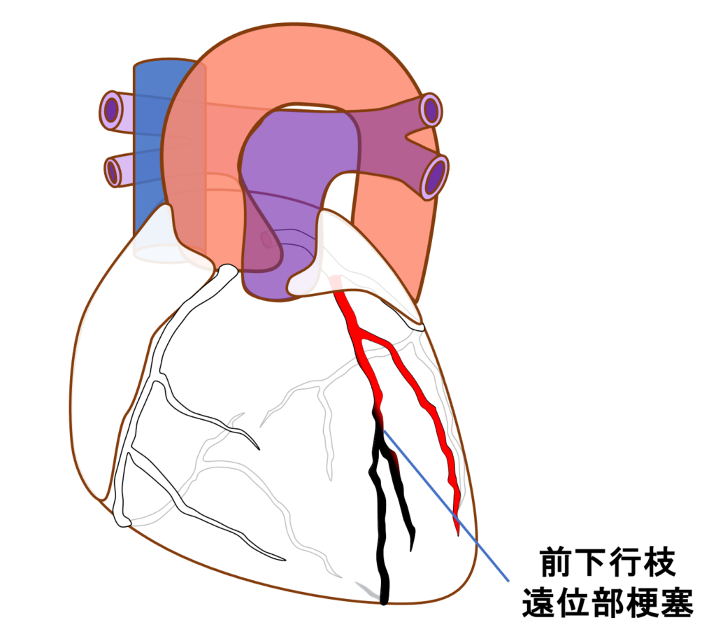 前壁心筋梗塞(anterior myocardial infarction)