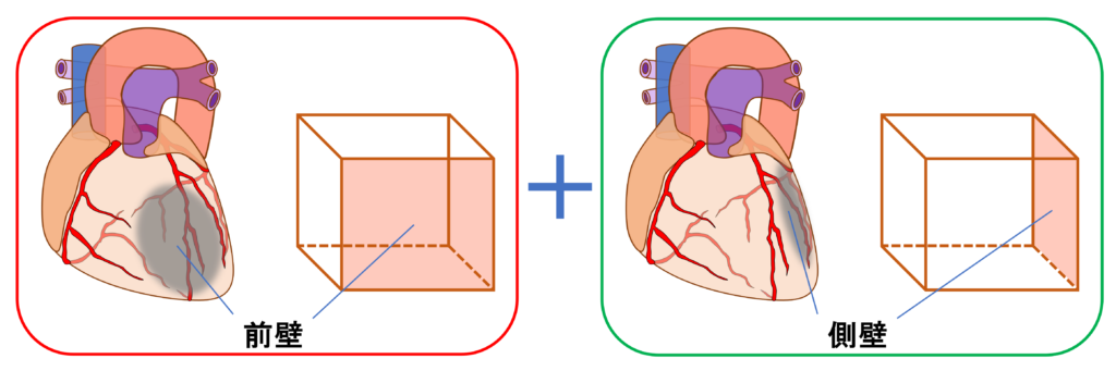 前壁心筋梗塞(anterior myocardial infarction)