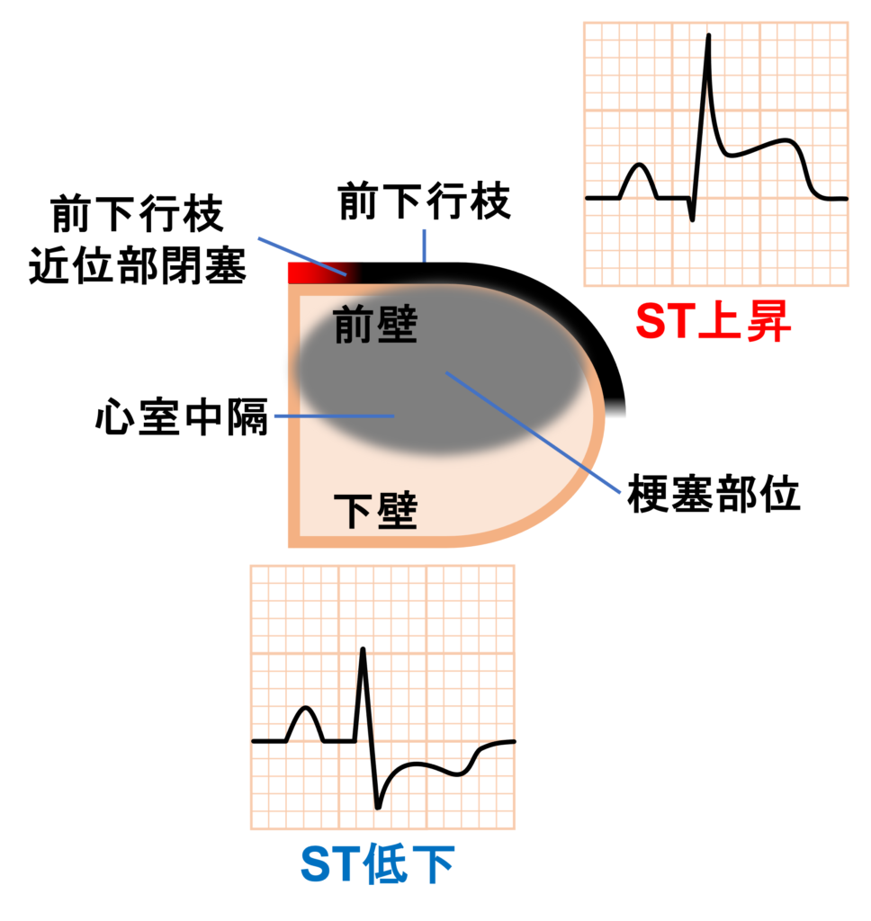 前壁心筋梗塞(anterior myocardial infarction)