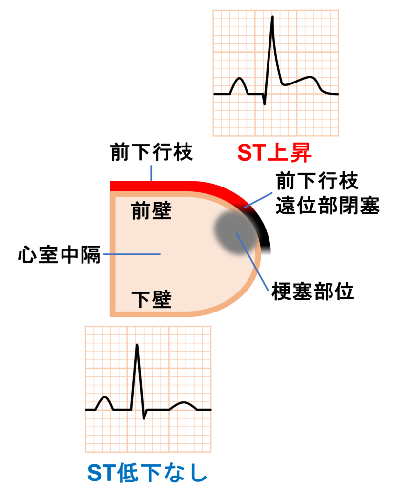 前壁心筋梗塞(anterior myocardial infarction)