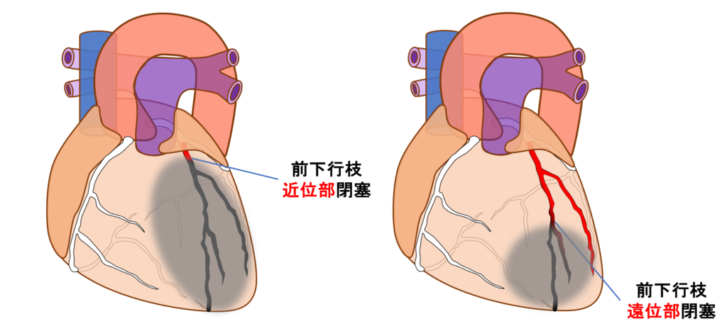 前壁心筋梗塞(anterior myocardial infarction)