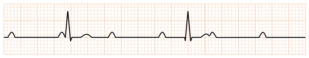 完全房室ブロック(complete atrioventricular block)