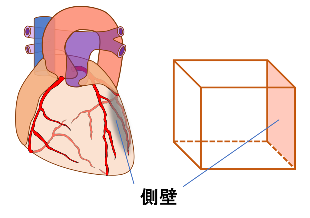 側壁心筋梗塞(lateral myocardial infarction)