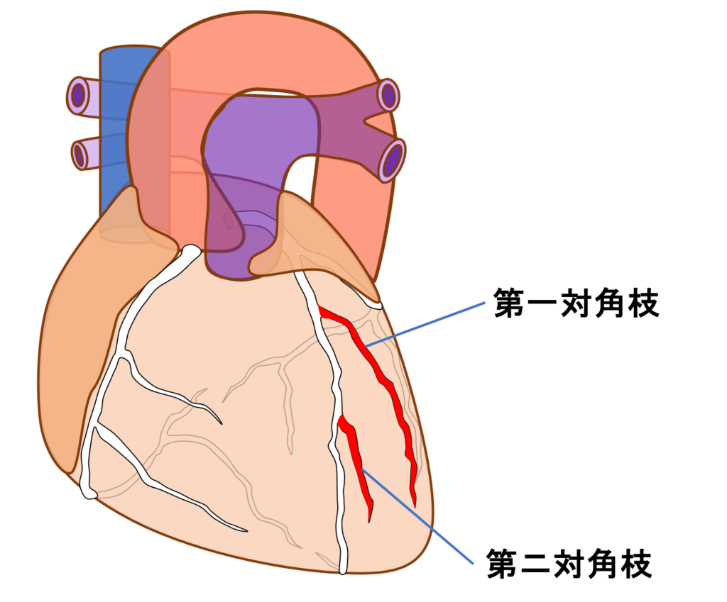 側壁心筋梗塞(lateral myocardial infarction)