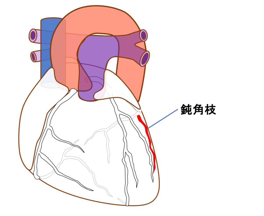 側壁心筋梗塞(lateral myocardial infarction)