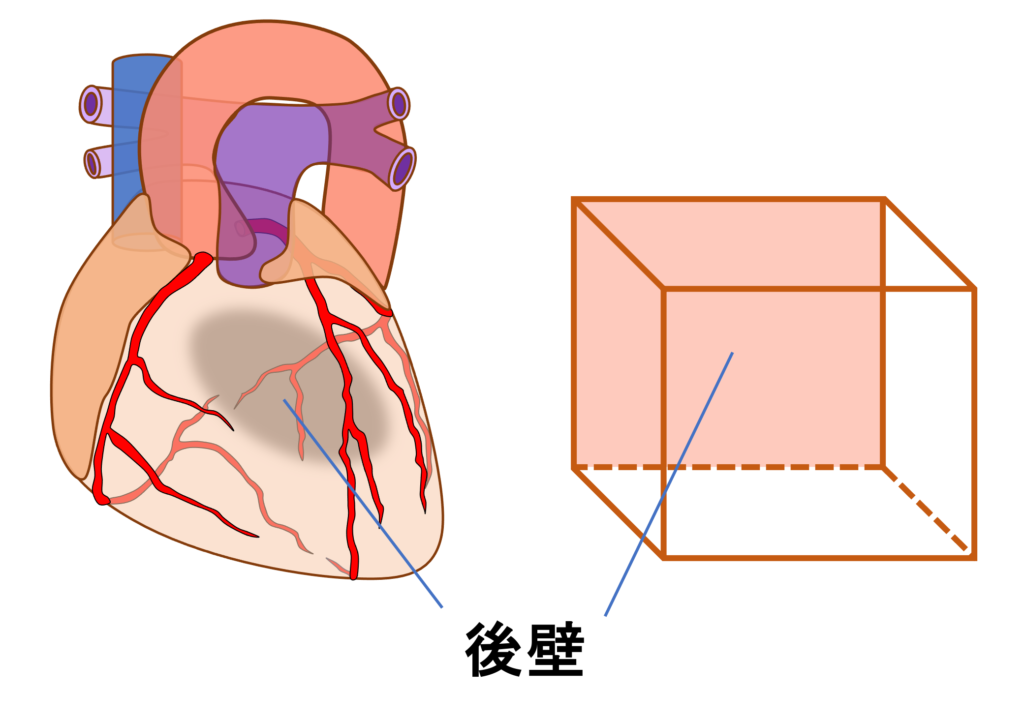 後壁心筋梗塞(posterior myocardial infarction)