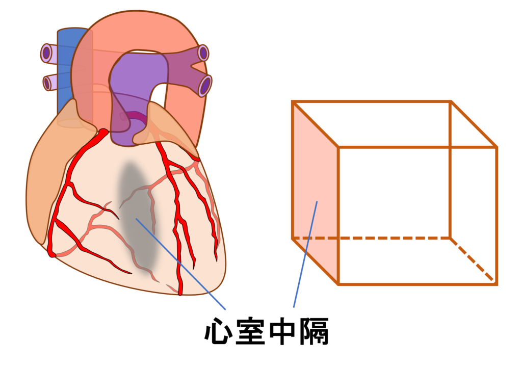 中隔心筋梗塞(septal myocardial infarction)