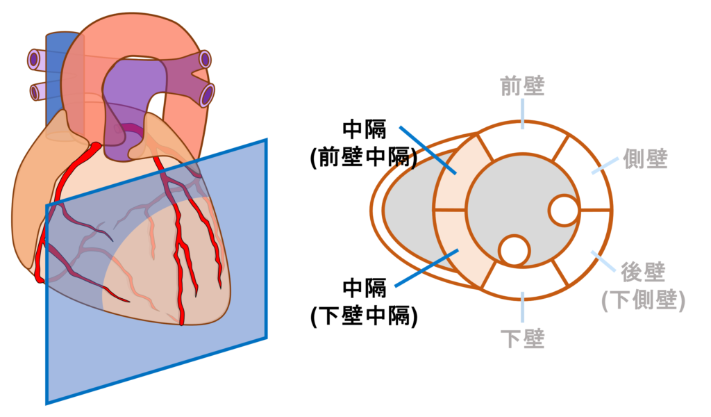 中隔心筋梗塞(septal myocardial infarction)