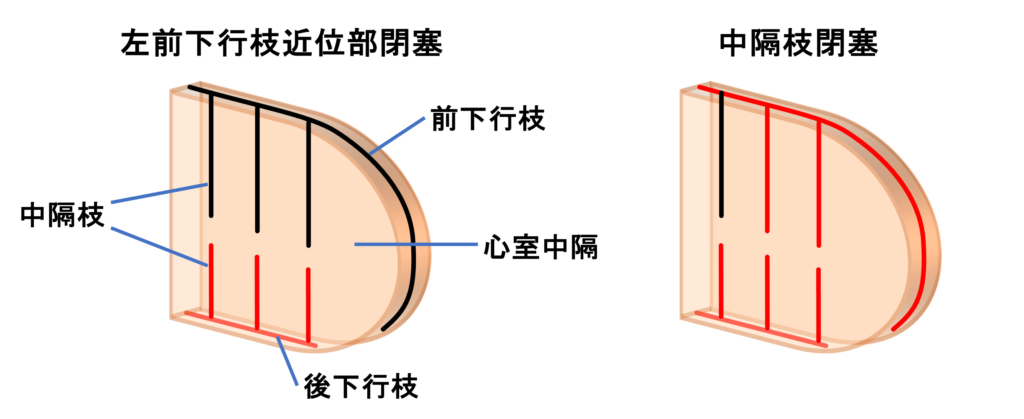 中隔心筋梗塞(septal myocardial infarction)