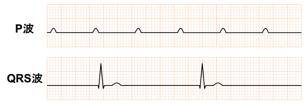 完全房室ブロック(complete atrioventricular block)