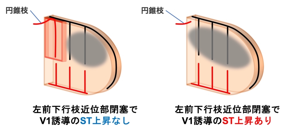 中隔心筋梗塞(septal myocardial infarction)