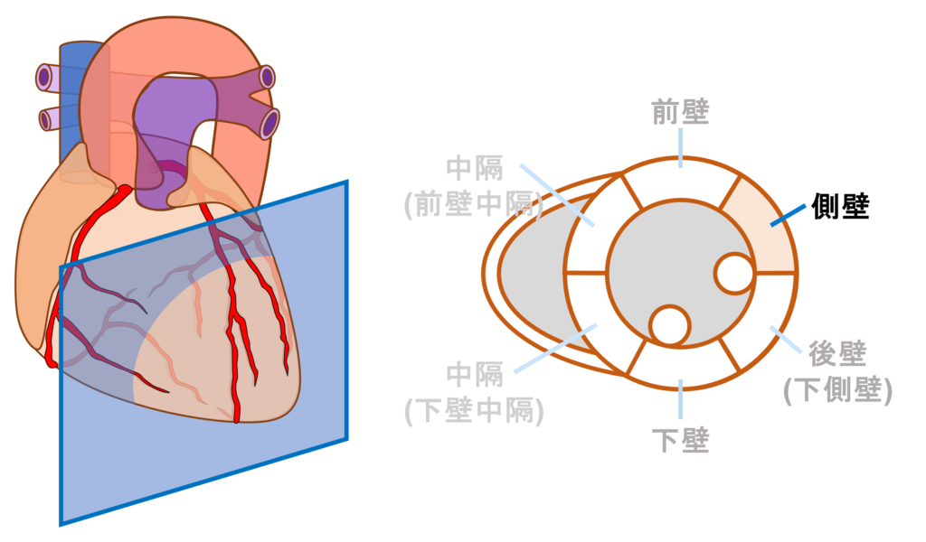 側壁心筋梗塞(lateral myocardial infarction)