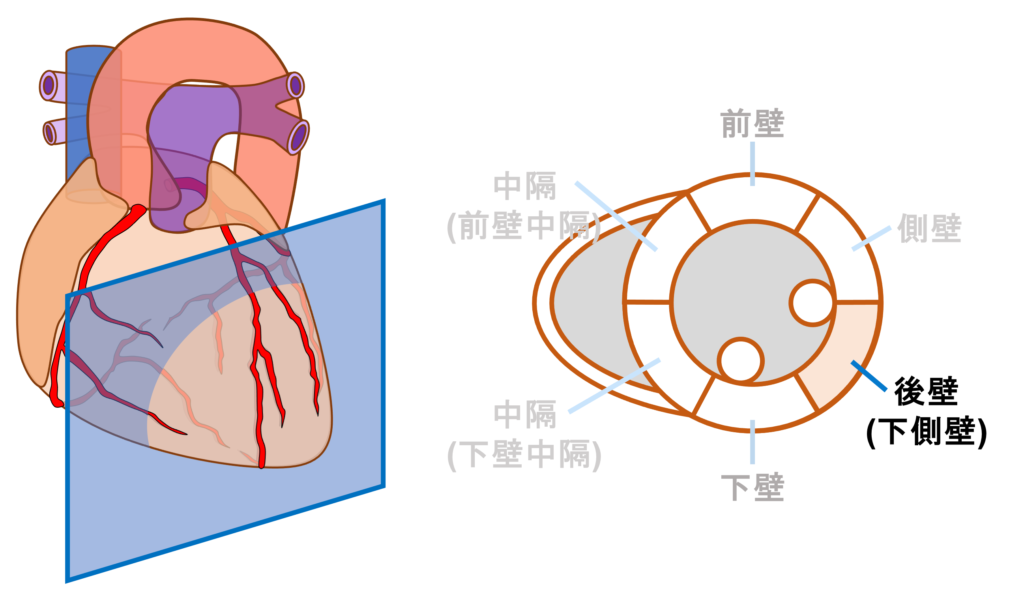 後壁心筋梗塞(posterior myocardial infarction)