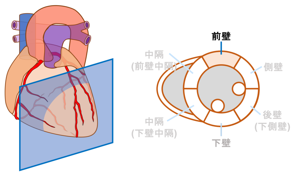 前壁心筋梗塞(anterior myocardial infarction)