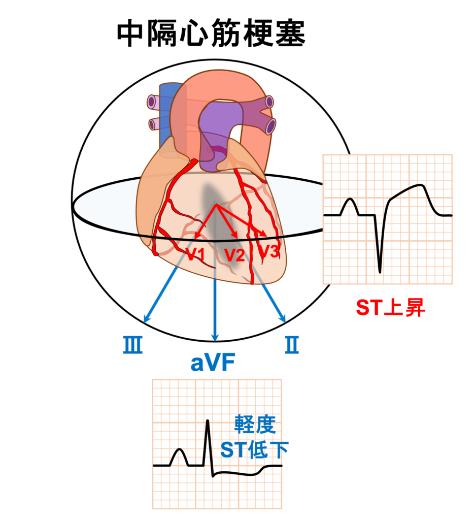 中隔心筋梗塞(septal myocardial infarction)