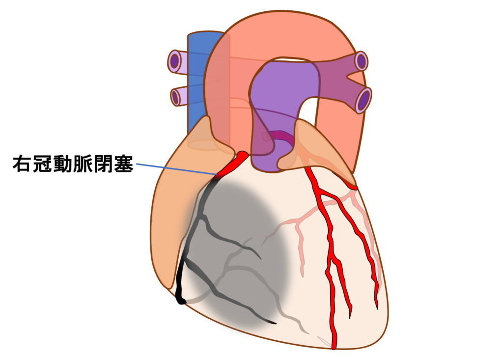 右室梗塞(right ventricular infarction)